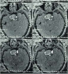 經(jīng)顱多普勒對顱內(nèi)動脈瘤的診斷價(jià)值 經(jīng)顱多普勒